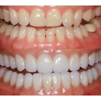 Отбеливающая система для зубов Smile Factor